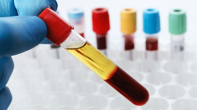 A hand holding a blood sample in a test tube with a red cap, showing a distinct separation of yellow and red liquids. 