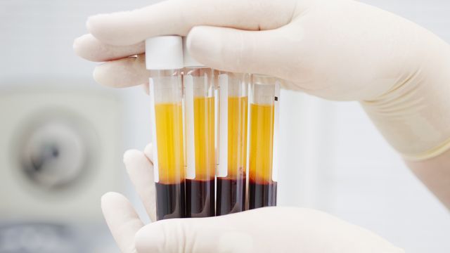 Blood plasma samples in test tubes for analysis in a plasma proteomics study.  